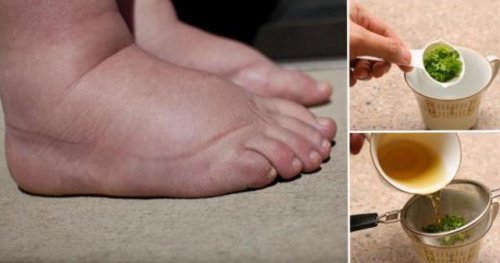 The Best Remedy to Relieve Swollen Feet