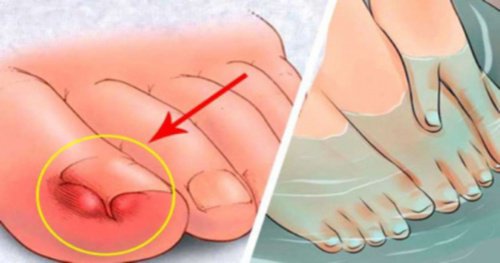Ingrown toenails - six home remedies