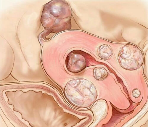 गर्भाशय फाईब्रॉइड 
