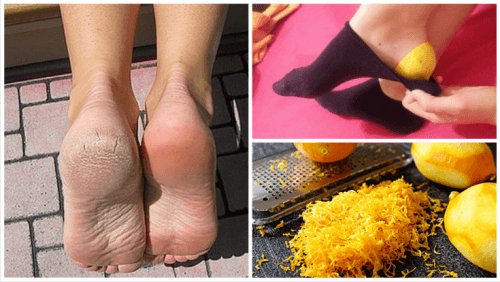Use Lemon Peels to Heal Your Feet