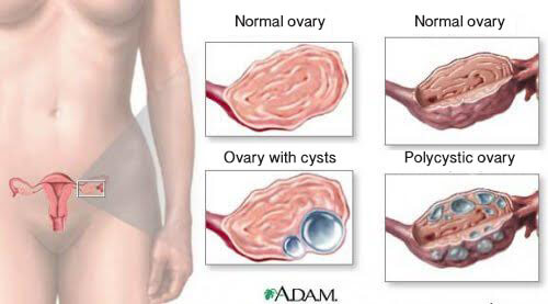 9 Important Facts about Ovarian Cysts