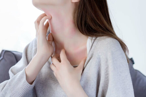 Hives are symptom of high stress levels.