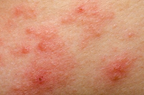 Sensitive skin