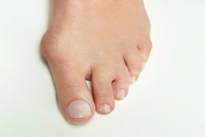 5 Home Remedies to Get Rid of Bunion Pain Fast