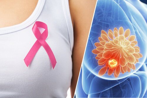 Detecting Breast Cancer Using a Pill