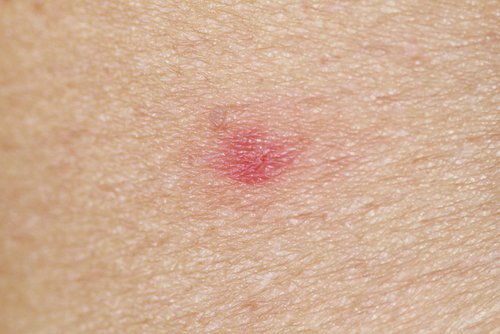 A close up of an insect bite.