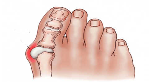 how to get rid of bunions how to get rid of bunions