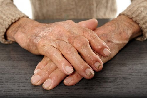 Arthritic hands folded one over the other flaxseed anti-inflammatory