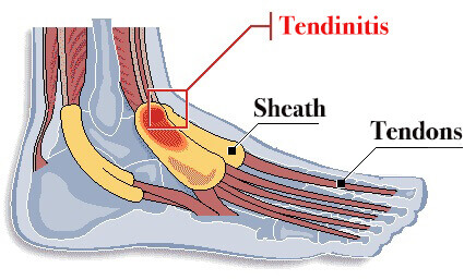 Tenosynovitis foot diagram