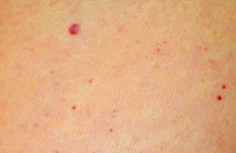 pinpoint red dots on skin that bleed