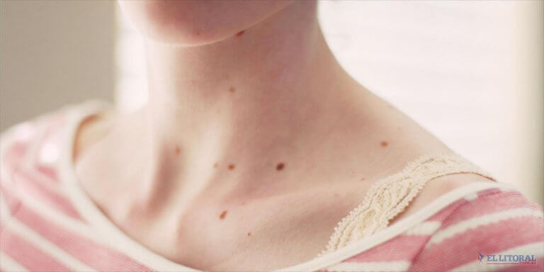 Red spots on the skin may be inherited from parents