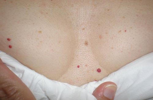 A lot of Red Spots on Skin: Should You Be Worried?