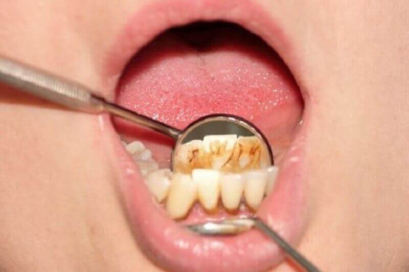 Tartar on a person's teeth.
