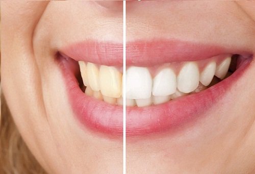 Teeth before and after whitening treatment