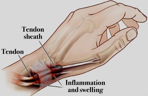 Tenosynovitis: Inflammation in the Hands and Feet