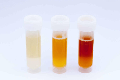 Different urine colors.