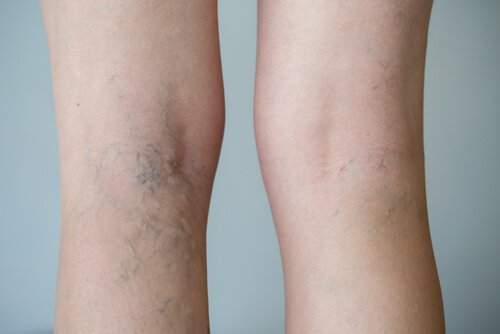 Tips to Help Relieve Varicose Vein Pain