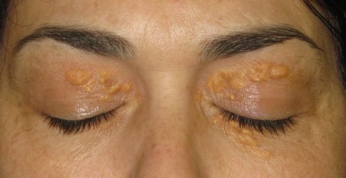 Xanthelasma: Those White Spots Around the Eyes