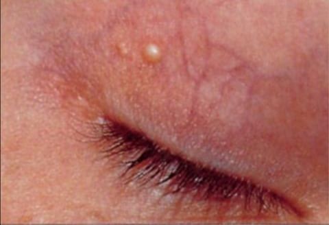 Xanthelasmas around the eyes.