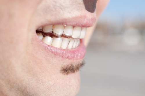 Man with bruxism 