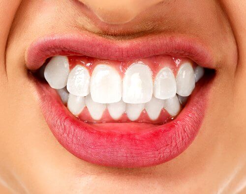 Bruxism: A Psychosomatic Disorder