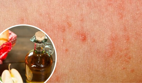 Removing Skin Fungus with Homemade Remedies