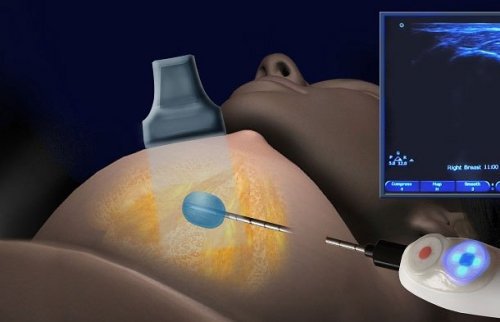 Cryoablation: A New Treatment Option for Breast Cancer Cryoablation: A New Treatment Option for Breast Cancer