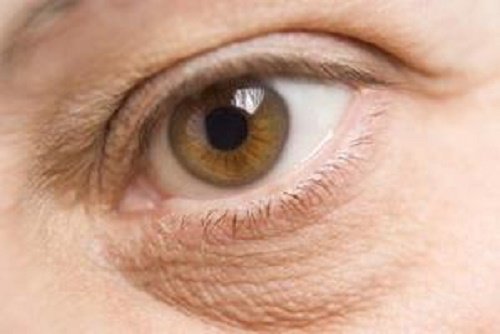 bags under the eyes, one of the negative effects of stress on your appearance