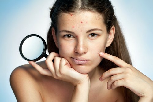 face acne