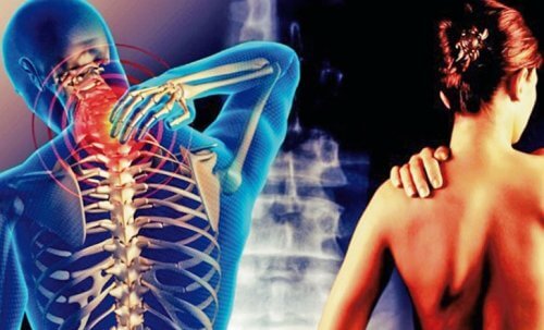 Cervicobrachial Syndrome, a Painful Neck and Arms