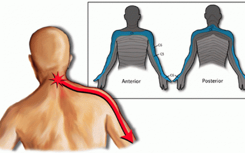 cervicobrachial-syndrome-pain-runs-from-your-neck-down-your-arms