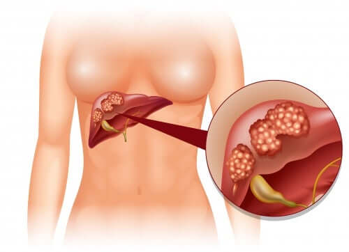 Cirrhosis.