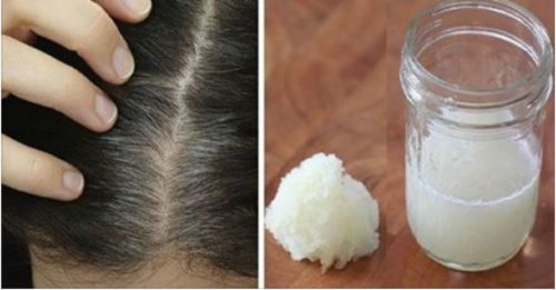 Onion and Honey Remedy to Reduce the Risk of Hair Loss