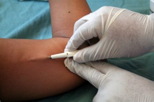 Gloved hands inserting subdermal contraceptive implant