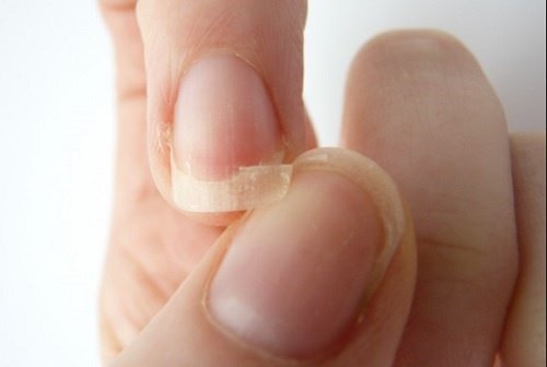 Close up of bitten nail