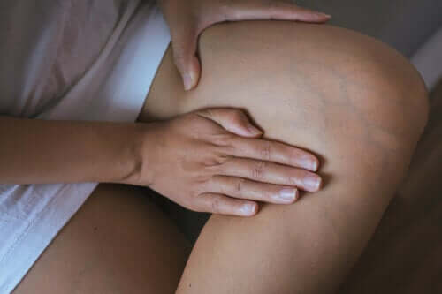 A person with fluid retention.