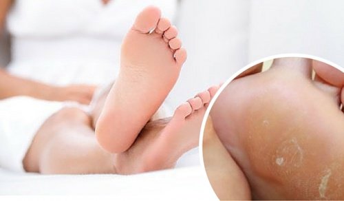 Remove Foot Calluses with These Home Remedies