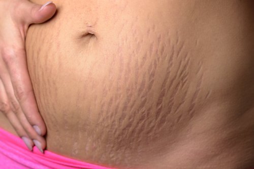 How to Remove Stretch Marks Naturally: 2 Easy Ways
