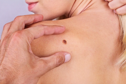 7 Things You Didn't Know About Skin Cancer