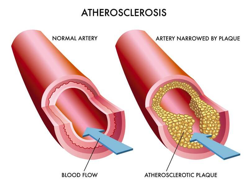 Atherosclerosis can reduce with the right treatment for bad cholesterol