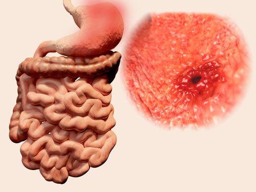 peptic ulcer feels like butterflies in your stomach