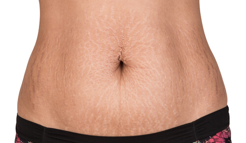 How to Remove Stretch Marks Naturally: 2 Easy Ways