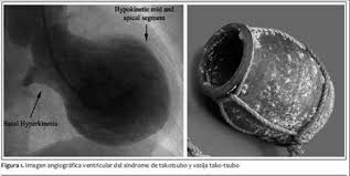 Broken-Heart-Syndrom - medizinisches Schaubild
