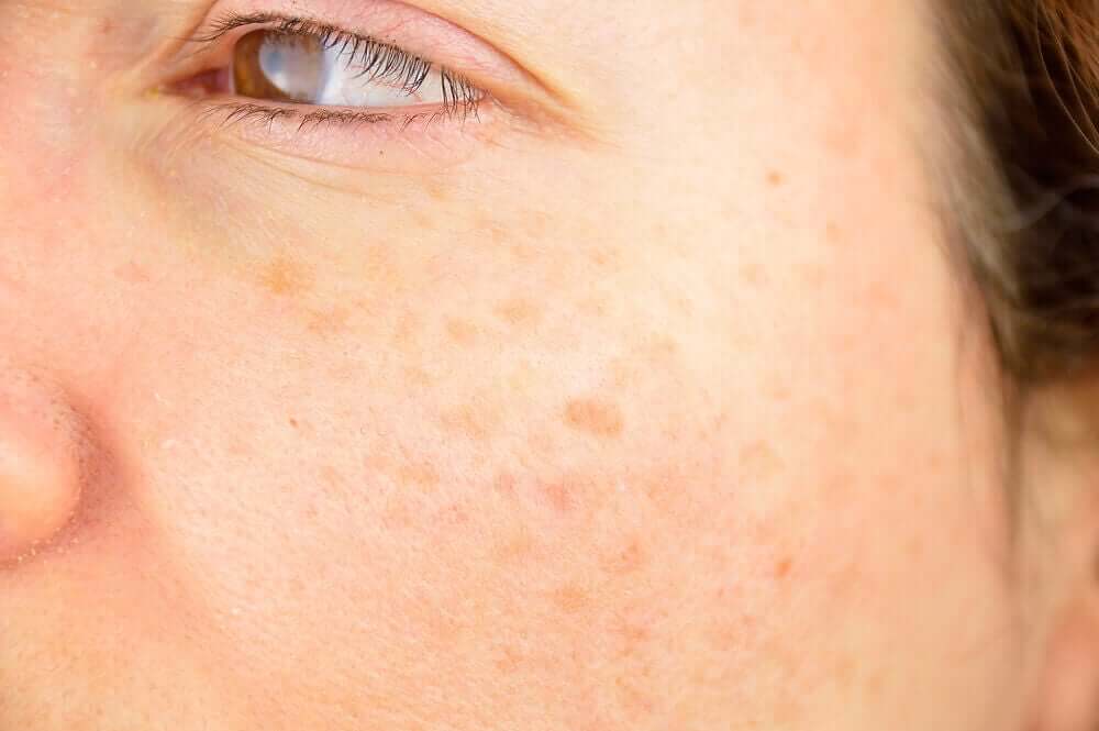 Dark spots on the face.