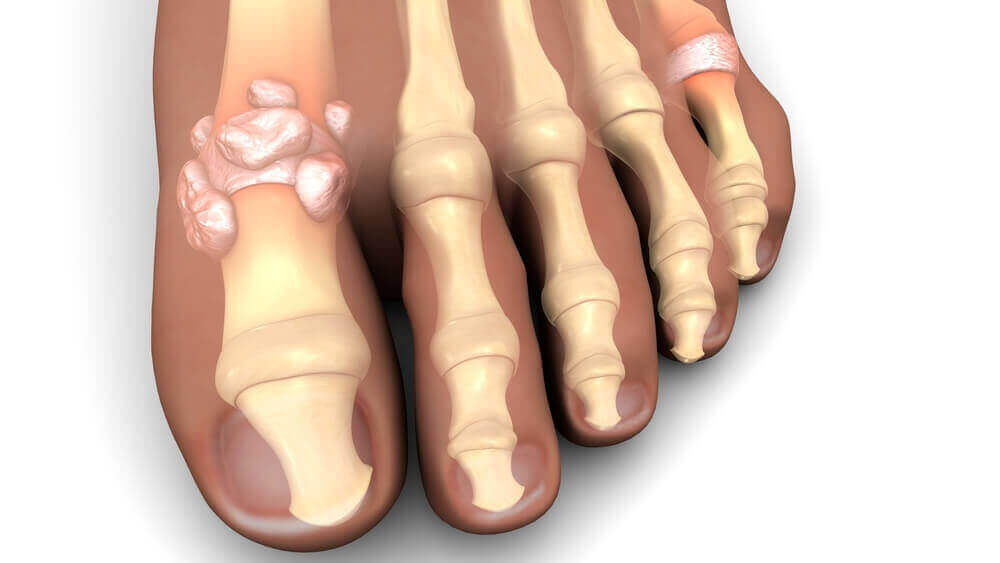 Nerve pain may be due to gout.