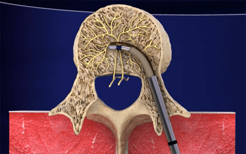 New procedures for chronic low back pain may be effective.