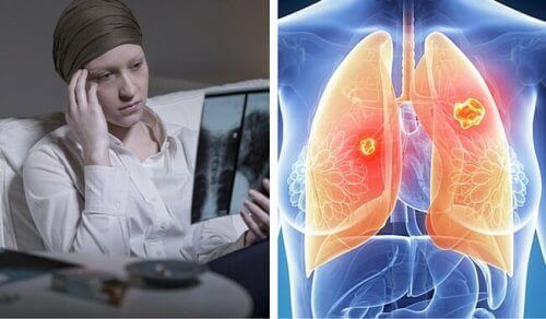 Kvinde med lungekræft