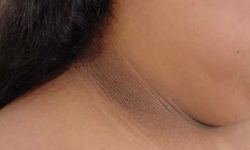 Four Ways to Lighten Dark Skin on Your Neck