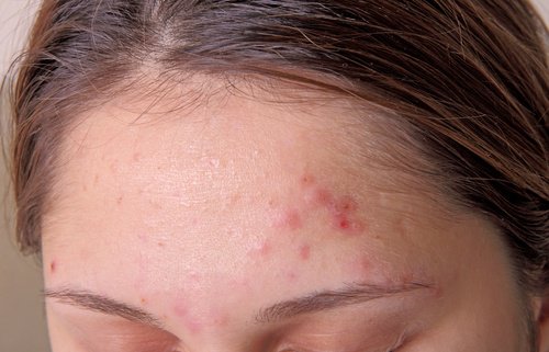 9 Signs You Are Overloaded with Toxins 9 Signs You Are Overloaded with Toxins
