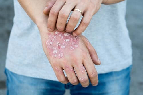 A person with psoriasis on their hand.